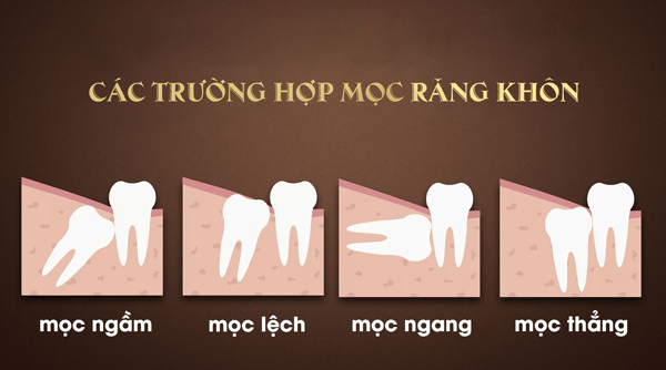 Các trường hợp răng khôn mọc