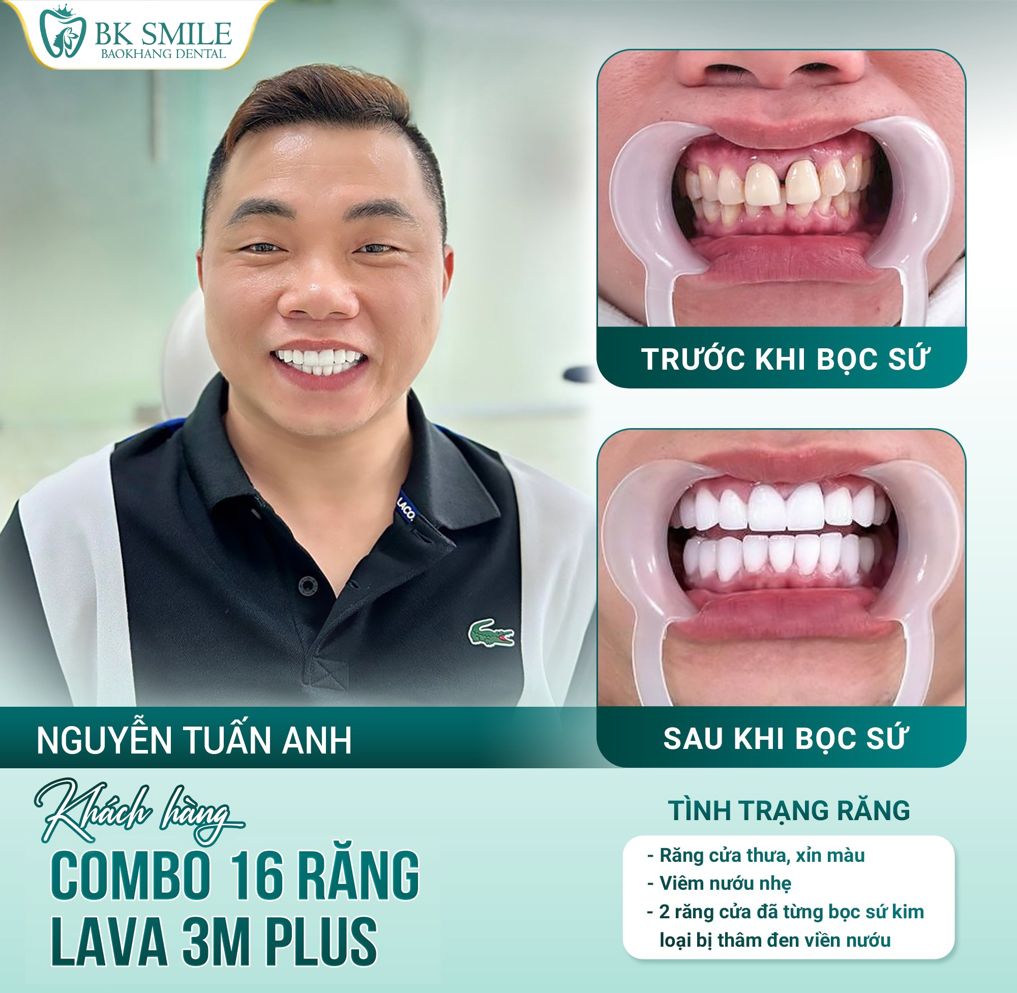 mất nhiều răng impant
