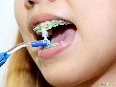 chăm sóc răng miệng sau khi niềng
