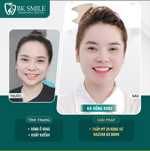 bọc sứ ht smile khắc phục răng khấp khểnh