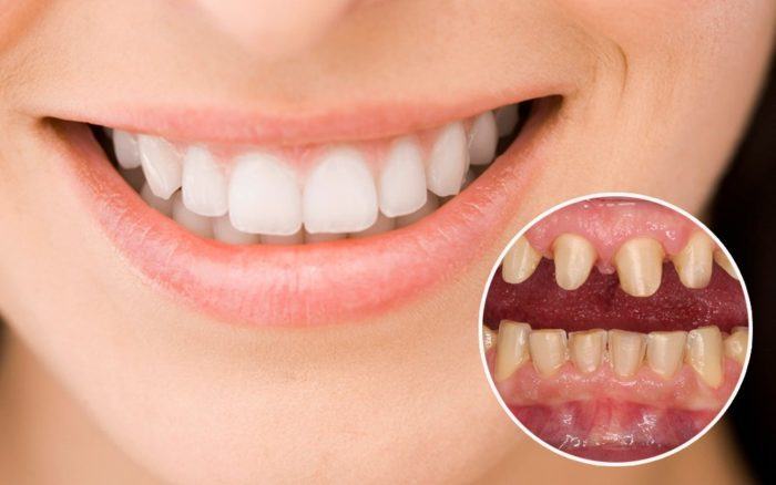bọc răng sứ phù hợp với cả những trường hợp răng bị hư hỏng nặng