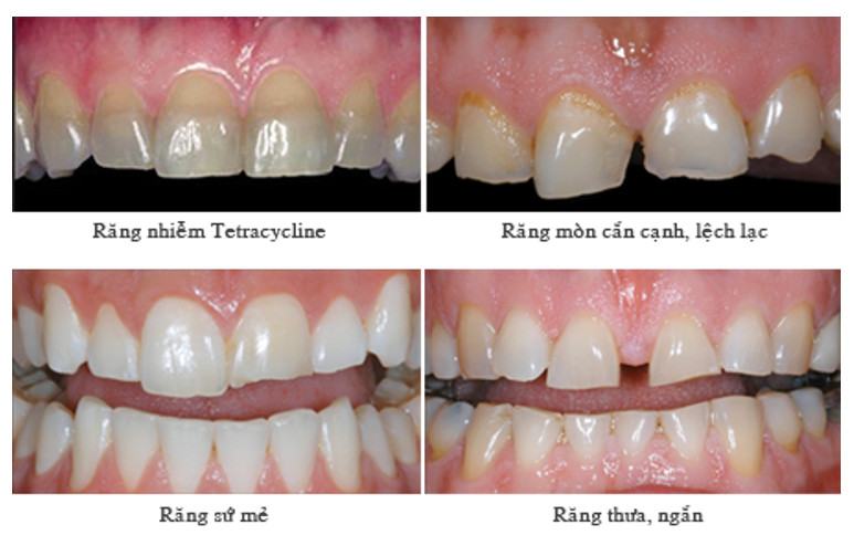các trường hợp bọc sứ