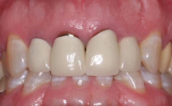 sứ kém chất lượng