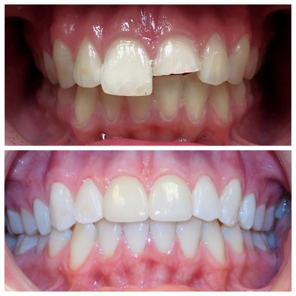 Bọc răng bị mẻ, gãy vỡ lớn
