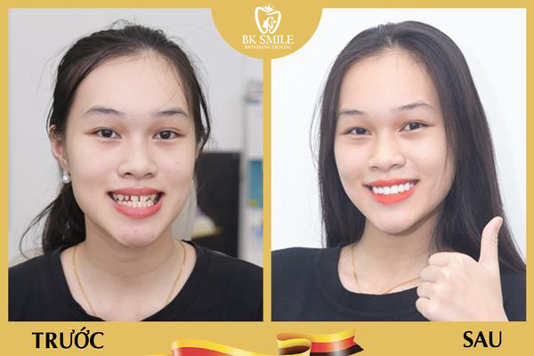 Lấy dấu răng