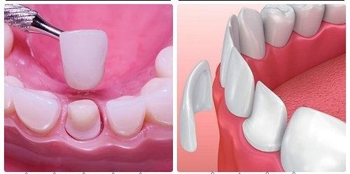 bọc răng sứ và dán sứ veneer