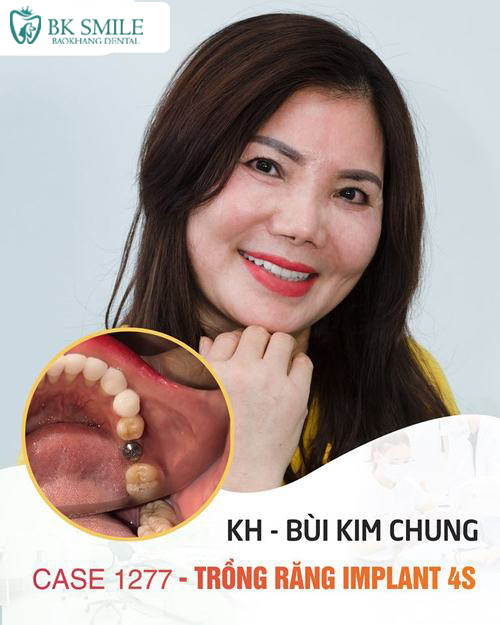trồng 1 răng 