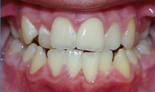 Khớp cắn đối đầu 