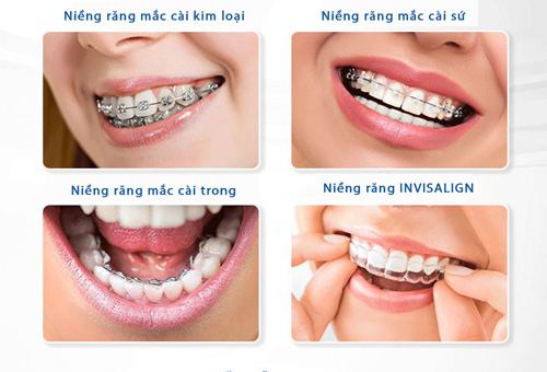 Niềng răng 