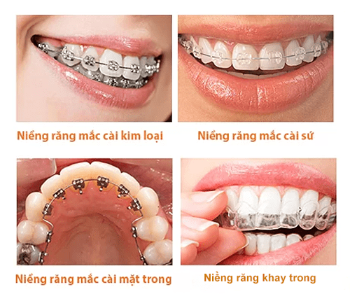 niềng răng là gì