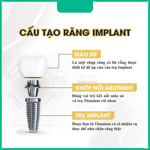 cấu tạo răng implant