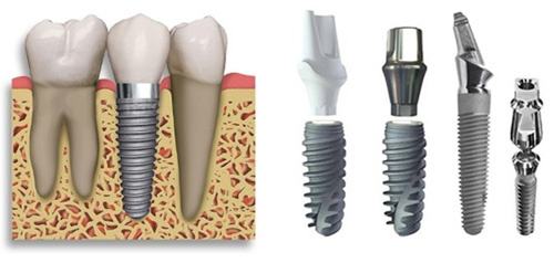 chất lượng trụ implant