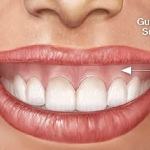cười hở lợi là gì