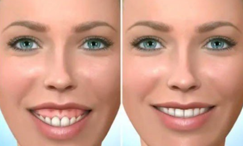 phẫu thuật cười hở lợi áp dụng trong trường hợp nào