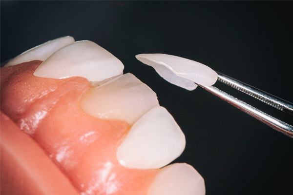 Công nghệ bọc răng sứ không mài