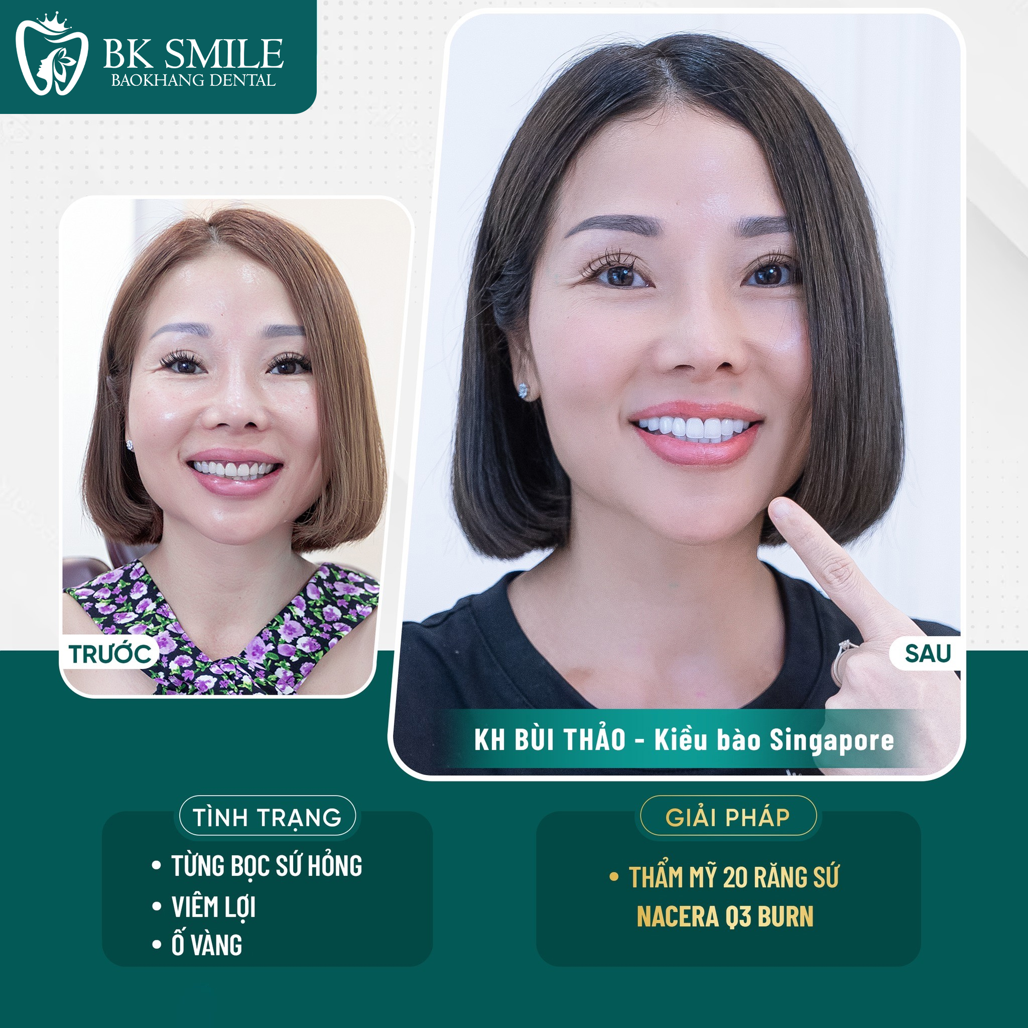 trước sau bọc sứ ht smile