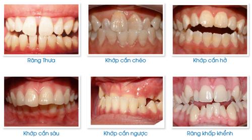 Các trường hợp áp dụng niềng răng mắc cài