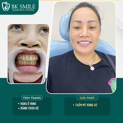 khách hàng bọc sứ ht smile