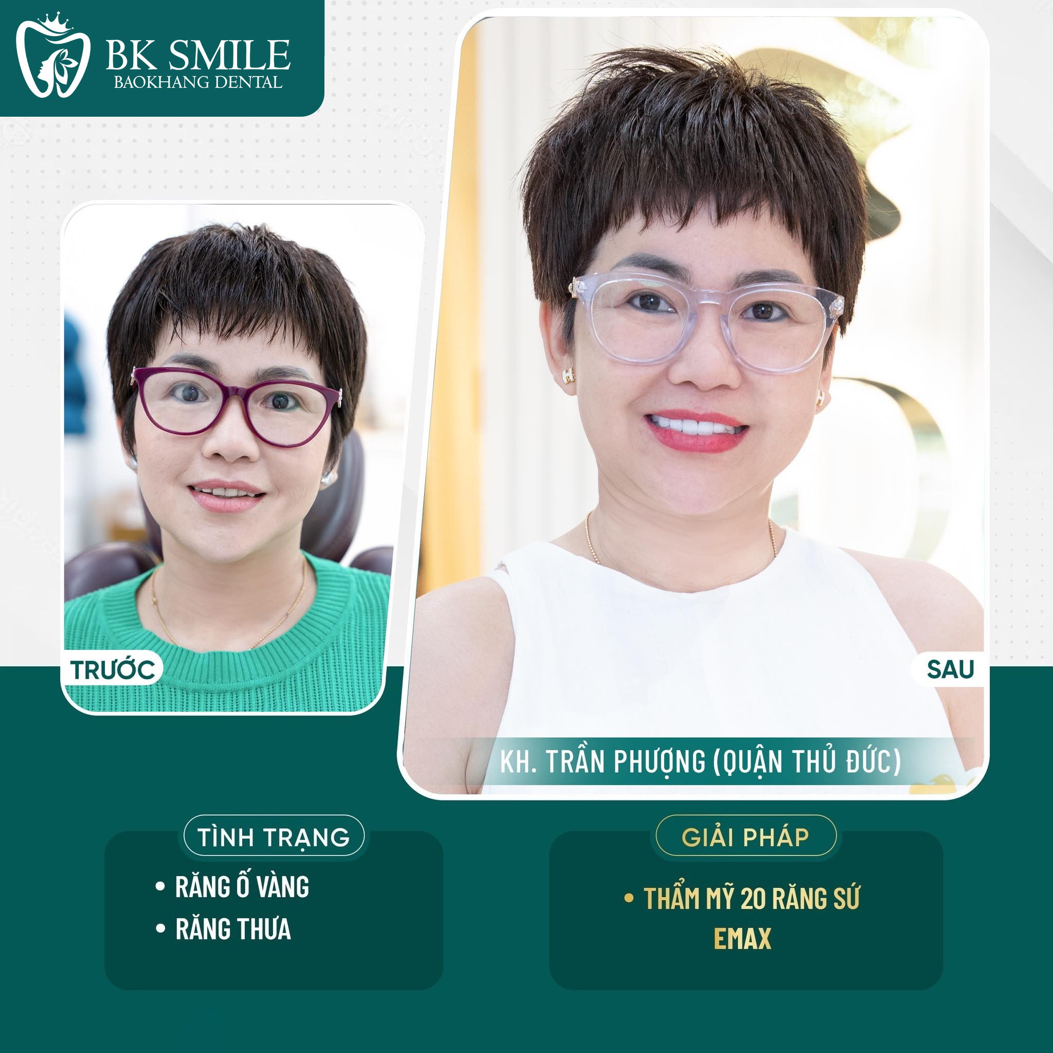 Khách hàng Nguyễn Linh thẩm mỹ 20 răng sứ Emax