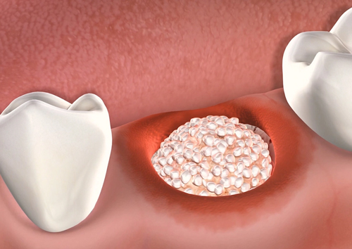 Ghép xương là giải pháp điều trị hỗ trợ trường hợp bị tiêu xương trong cấy Implant 