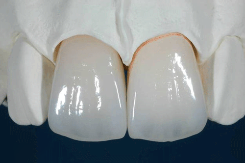 răng sứ ht smile có tốt không
