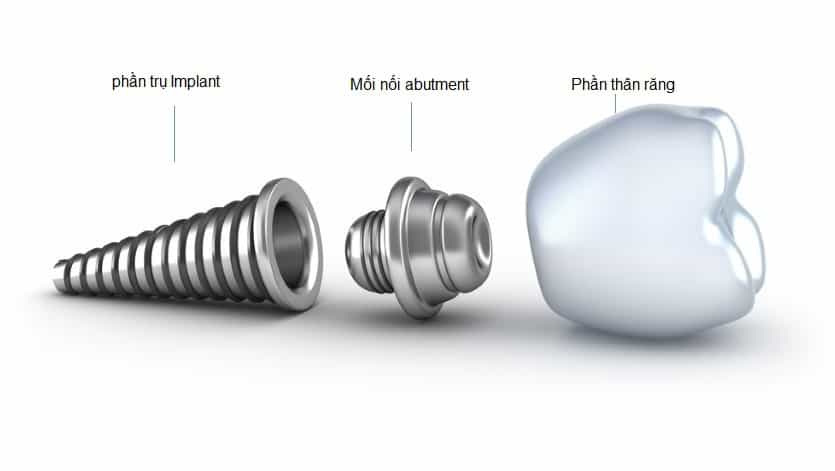 cấu tạo của implant