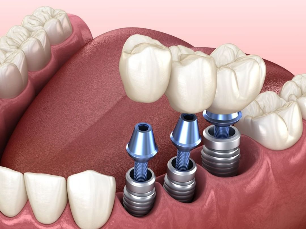 trồng răng implant là gì