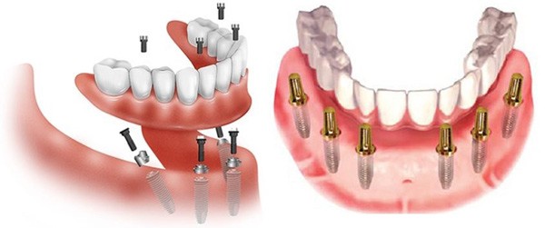 trồng răng implant nguyên hàm