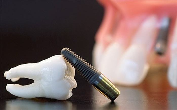 trụ implant là gì 