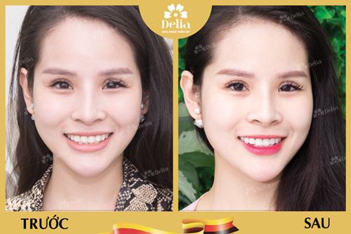 Hình ảnh thay đổi của khách hàng Cẩm Linh sau khi bọc răng sứ