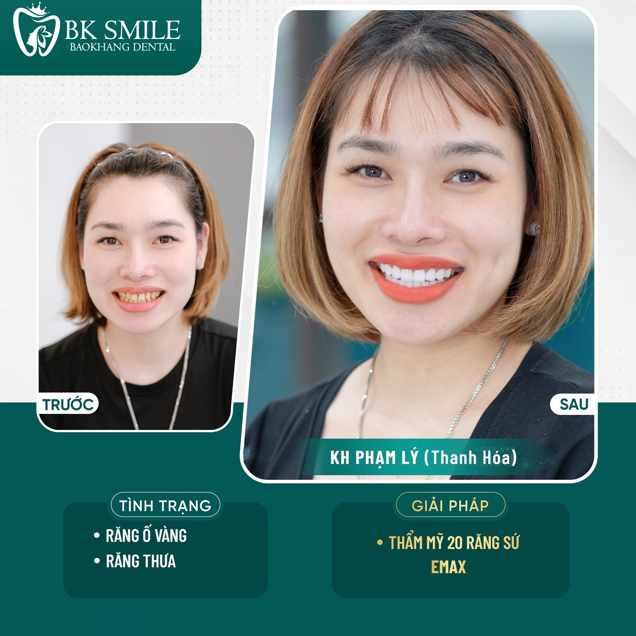 Nữ DJ Dương Tây dán sứ 20 răng HT Smile