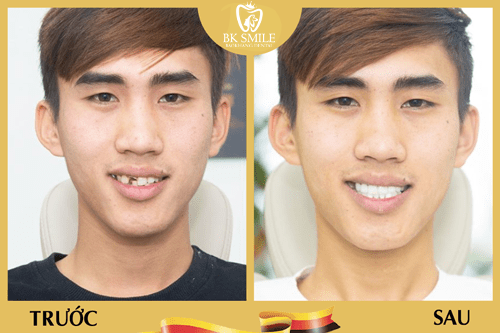 khách hàng làm cầu răng sứ 