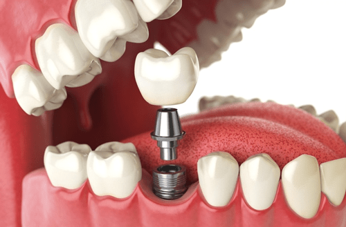 công nghệ trồng răng implant 4s