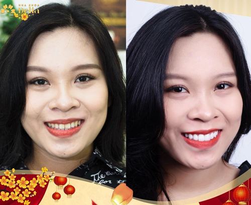 Khách hàng Thanh Phương trước và sau khi dán sứ Veneer răng thỏ