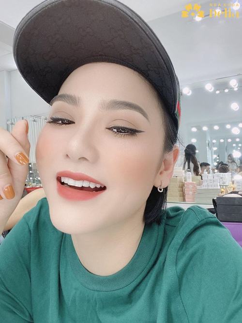 Kết quả của DJ Dương Tây sau bọc sứ răng thỏ Emax 