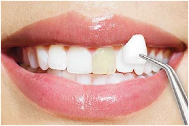 Những trường hợp có thể áp dụng làm răng