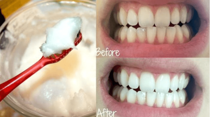 Làm trắng răng bằng nước vo gạo