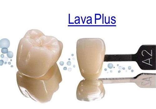 Đánh giá ưu điểm của răng sứ Lava Plus