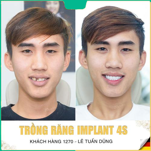 khách trồng nhiều răng implant 