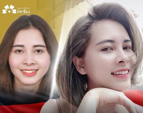 Khách hàng Ngô Hồng Mến cực cá tính nhờ phương pháp bọc sứ răng thỏ