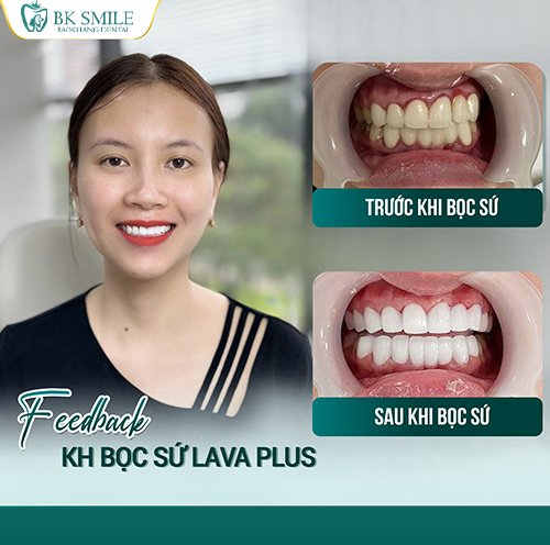 Khách hàng Ngô Tuyết dán sứ 18 răng Emax 