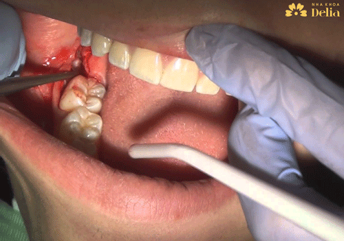 Nhổ răng khôn có đau và chảy máu nhiều không
