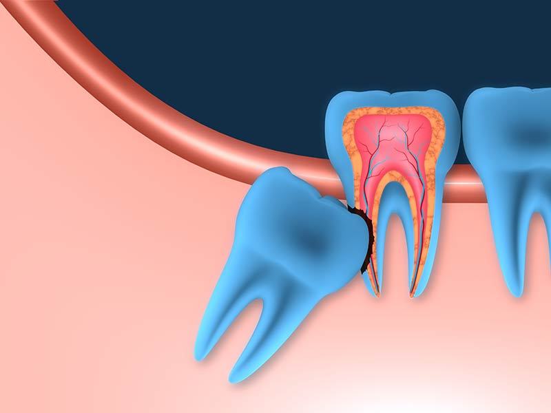 Cần phải nhổ bỏ răng khôn khi răng mọc ảnh hưởng đến răng kế cận