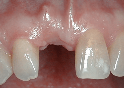 điều kiện cấy ghép implant
