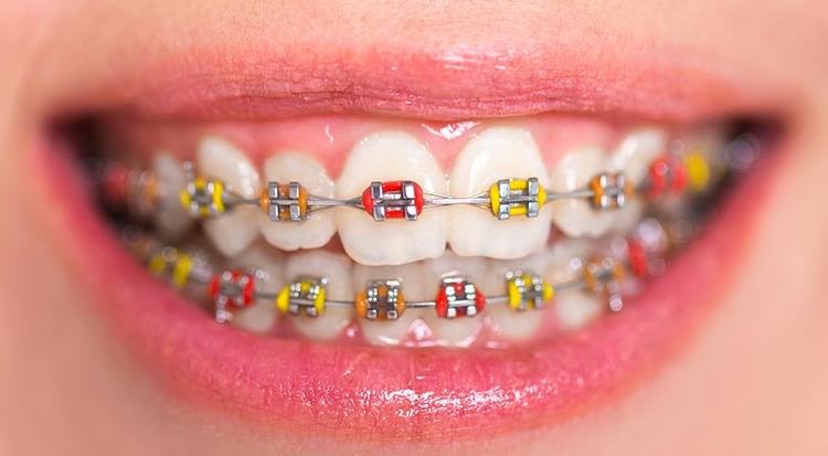 Niềng răng kim loại truyền thống