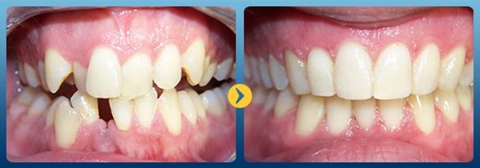hình ảnh khách hàng niềng răng