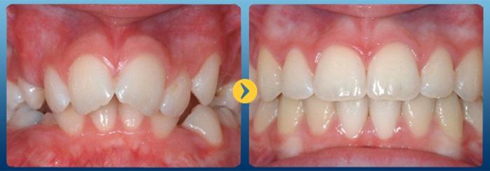 Hình ảnh khách hàng trước và sau khi niềng răng tại Nha khoa Bảo Khang