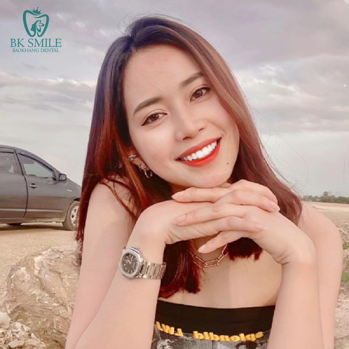 Khách hàng Phương Thảo – Bọc sứ 20 răng Lisi