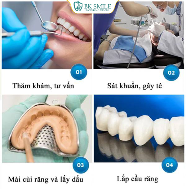 quy trình làm cầu sứ