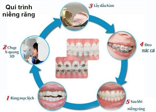 Quy trình niềng răng mắc cài tại nha khoa Bảo Khang